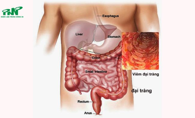 Điều trị viêm đại tràng bằng cách nào mang lại hiệu quả cao?